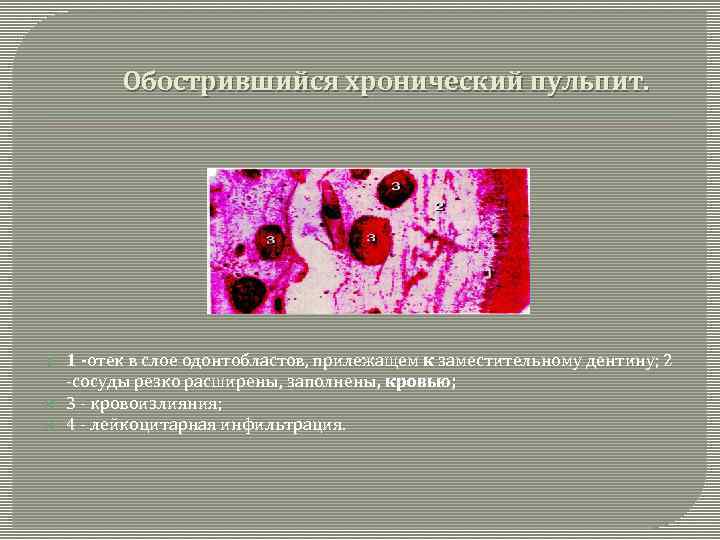 Обострившийся хронический пульпит. 1 -отек в слое одонтобластов, прилежащем к заместительному дентину; 2 -сосуды