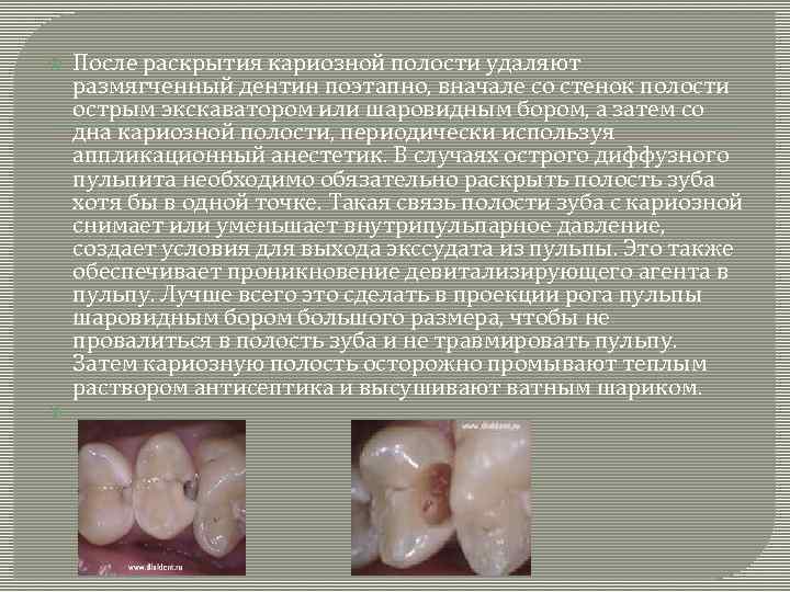  После раскрытия кариозной полости удаляют размягченный дентин поэтапно, вначале со стенок полости острым