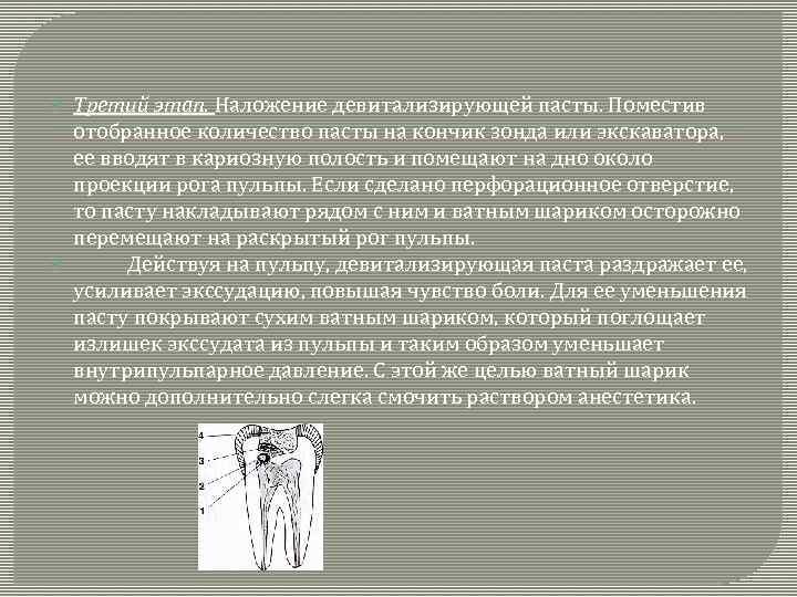  Третий этап. Наложение девитализирующей пасты. Поместив отобранное количество пасты на кончик зонда или