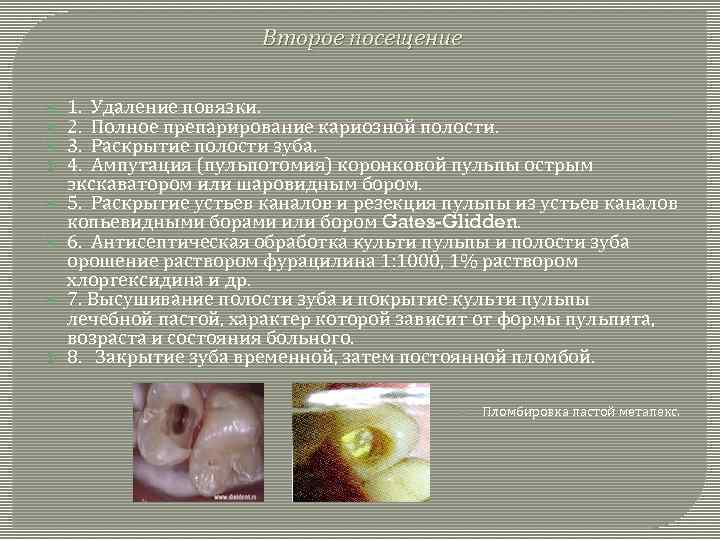 Второе посещение 1. Удаление повязки. 2. Полное препарирование кариозной полости. 3. Раскрытие полости зуба.