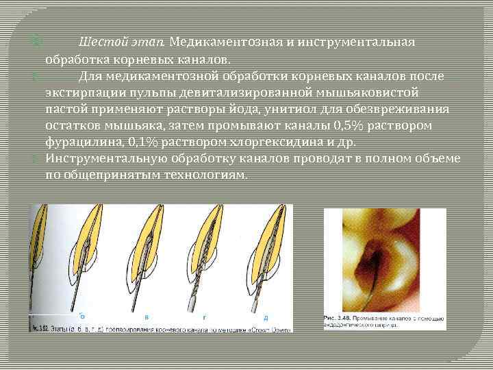  Шестой этап. Медикаментозная и инструментальная обработка корневых каналов. Для медикаментозной обработки корневых каналов