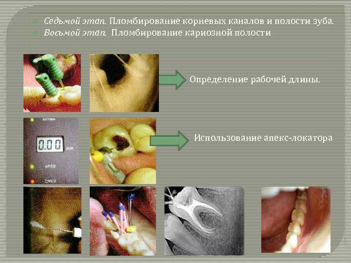  Седьмой этап. Пломбирование корневых каналов и полости зуба. Восьмой этап. Пломбирование кариозной полости