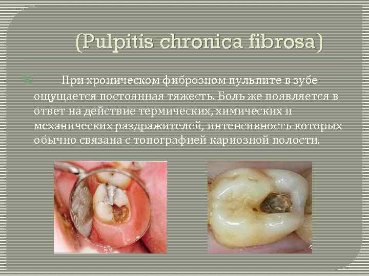 (Pulpitis chronica fibrosa) При хроническом фиброзном пульпите в зубе ощущается постоянная тяжесть. Боль же