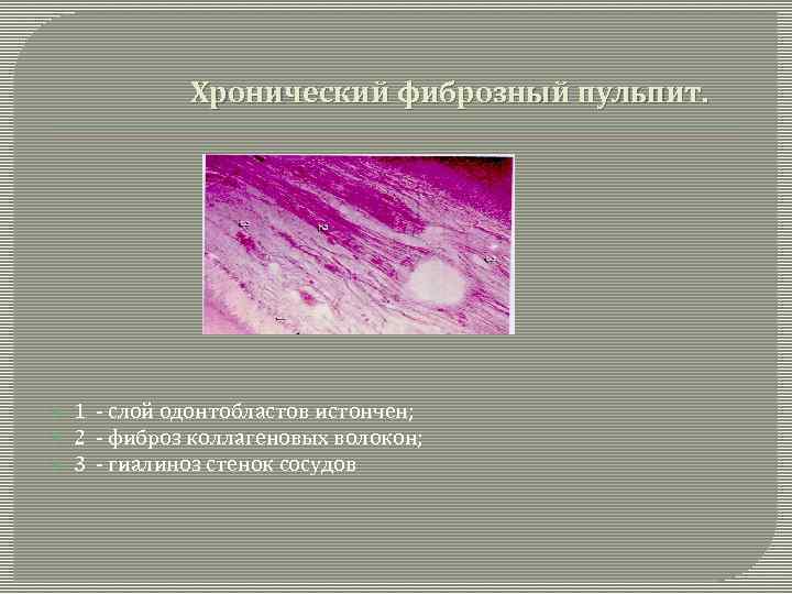  Хронический фиброзный пульпит. 1 - слой одонтобластов истончен; 2 - фиброз коллагеновых волокон;