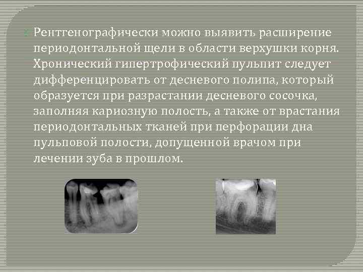  Рентгенографически можно выявить расширение периодонтальной щели в области верхушки корня. Хронический гипертрофический пульпит