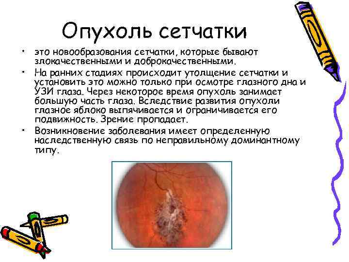 Опухоль сетчатки • это новообразования сетчатки, которые бывают злокачественными и доброкачественными. • На ранних
