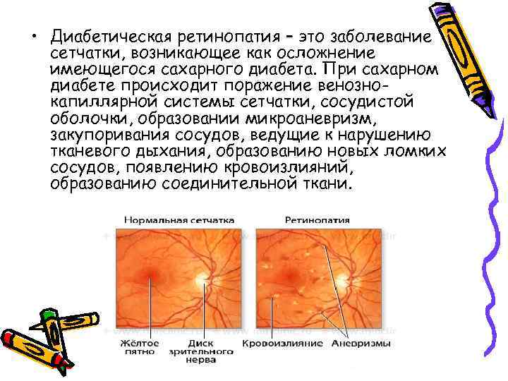 Диабетическая ретинопатия презентация