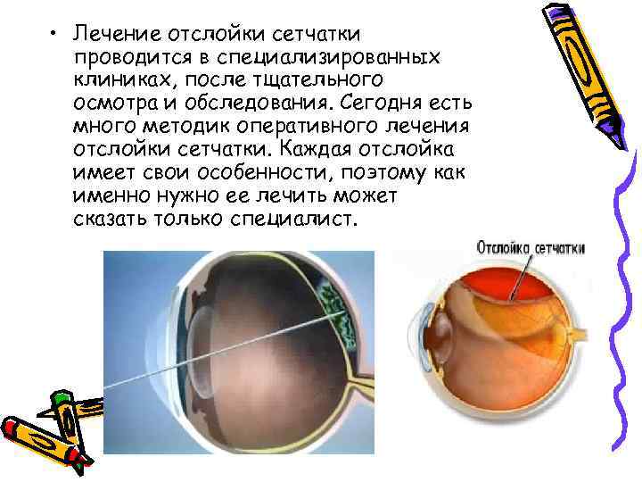  • Лечение отслойки сетчатки проводится в специализированных клиниках, после тщательного осмотра и обследования.