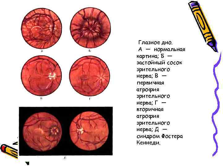 Нормальная офтальмоскопическая картина