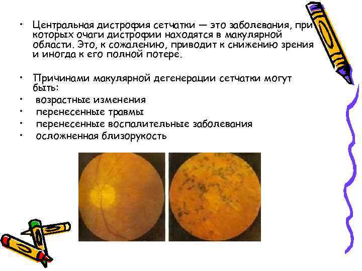  • Центральная дистрофия сетчатки — это заболевания, при которых очаги дистрофии находятся в