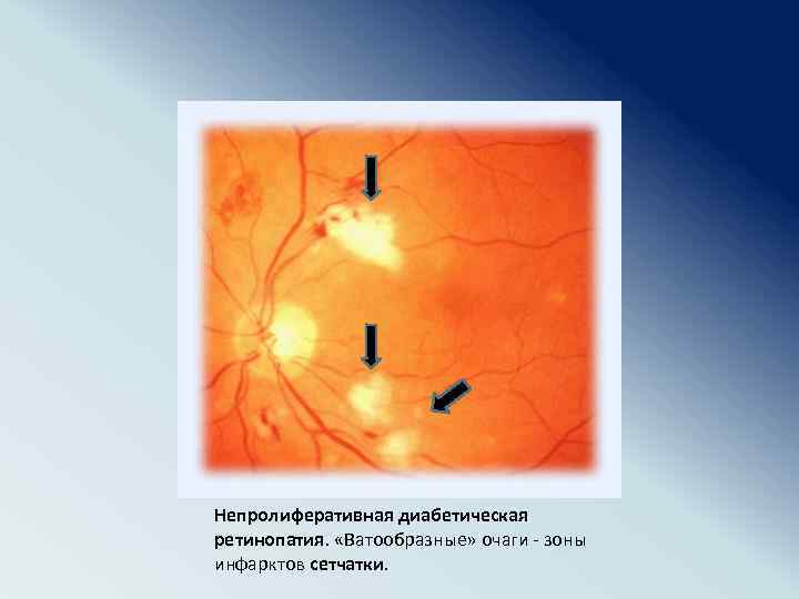 Непролиферативная диабетическая ретинопатия. «Ватообразные» очаги - зоны инфарктов сетчатки. 