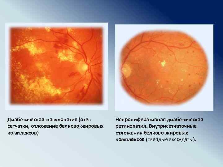 Диабетическая макулопатия (отек сетчатки, отложение белково-жировых комплексов). Непролиферативная диабетическая ретинопатия. Внутрисетчаточные отложения белково-жировых комплексов