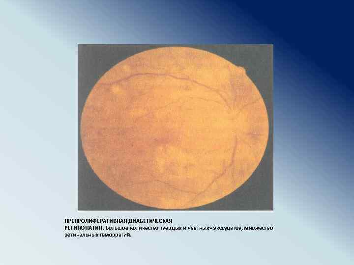 ПРЕПРОЛИФЕРАТИВНАЯ ДИАБЕТИЧЕСКАЯ РЕТИНОПАТИЯ. Большое количество твердых и «ватных» экссудатов, множество ретинальных геморрагий. 