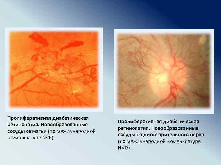 Пролиферативная диабетическая ретинопатия. Новообразованные сосуды сетчатки (по международной номенклатуре NVE). Пролиферативная диабетическая ретинопатия. Новообразованные