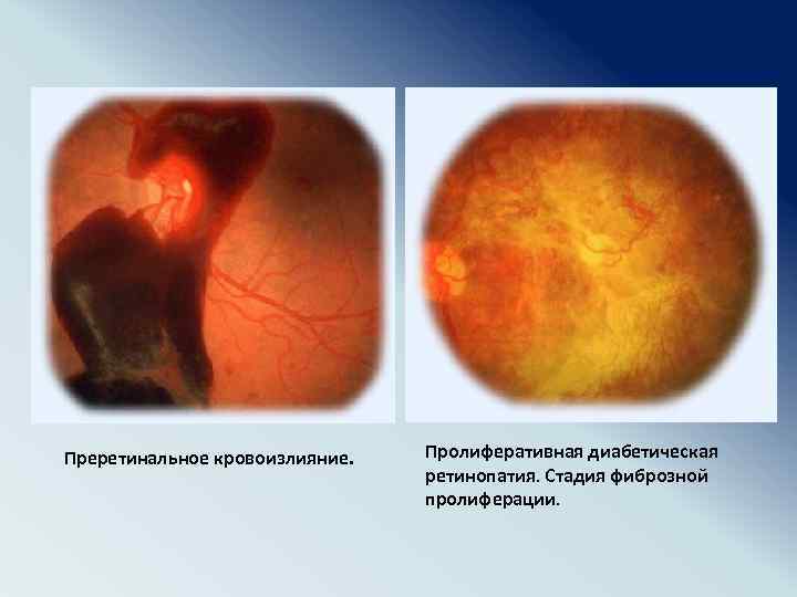 Преретинальное кровоизлияние. Пролиферативная диабетическая ретинопатия. Стадия фиброзной пролиферации. 