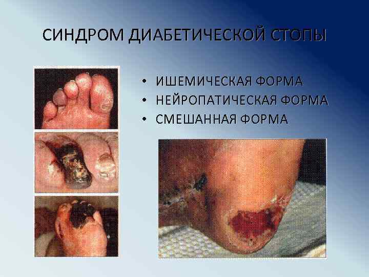 СИНДРОМ ДИАБЕТИЧЕСКОЙ СТОПЫ • • • ИШЕМИЧЕСКАЯ ФОРМА НЕЙРОПАТИЧЕСКАЯ ФОРМА СМЕШАННАЯ ФОРМА 
