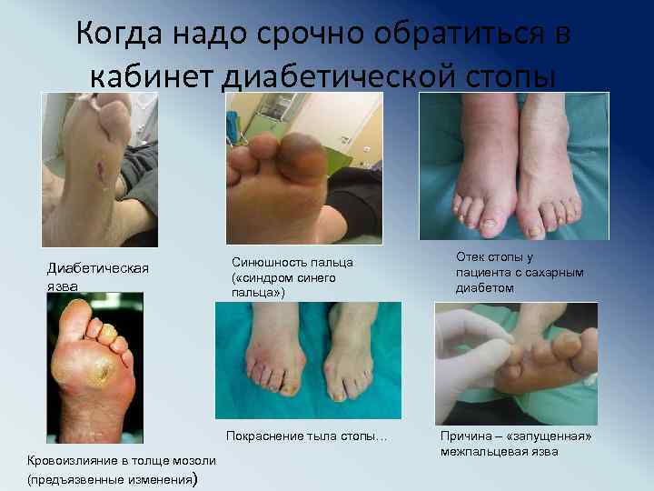 Когда надо срочно обратиться в кабинет диабетической стопы Диабетическая язва Синюшность пальца ( «синдром