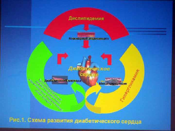 Коронарный атеросклероз Диабетический миокард Микроциркуляция 