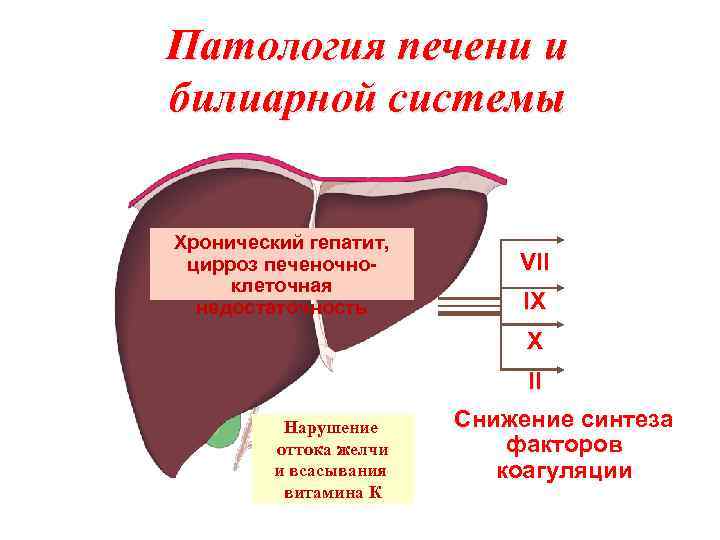 Патология печени и билиарной системы Хронический гепатит, цирроз печеночноклеточная недостаточность VII IX X II
