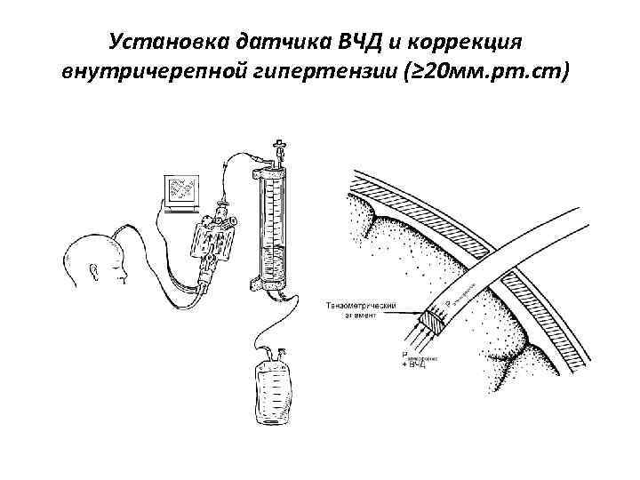 Установка датчика ВЧД и коррекция внутричерепной гипертензии (≥ 20 мм. рт. ст) 