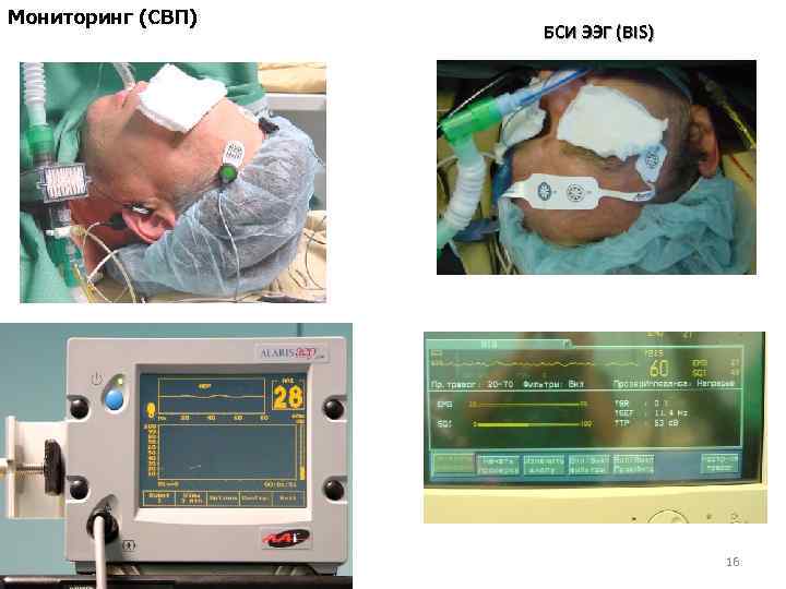 Мониторинг (СВП) БСИ ЭЭГ (BIS) 16 