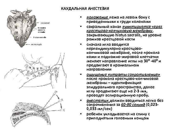 КАУДАЛЬНАЯ АНЕСТЕЗИЯ • • • положение лежа на левом боку с приведенными к груди