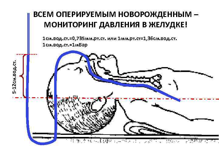 ВСЕМ ОПЕРИРУЕМЫМ НОВОРОЖДЕННЫМ – МОНИТОРИНГ ДАВЛЕНИЯ В ЖЕЛУДКЕ! 5 -12 см. вод. ст. 1