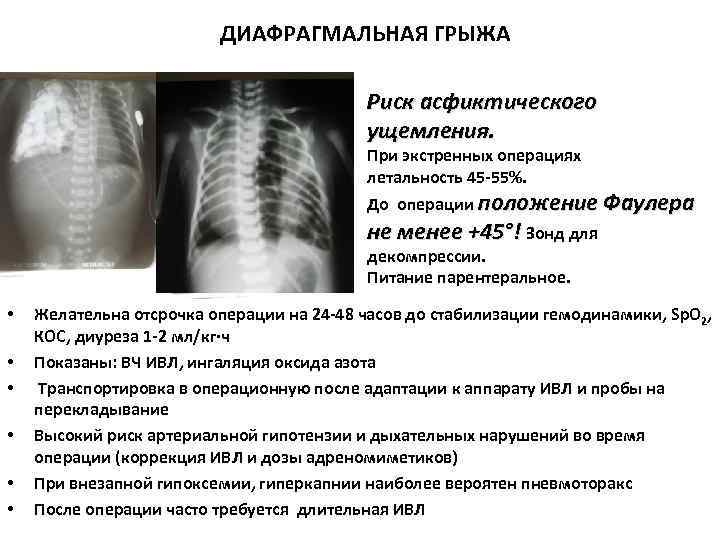 ДИАФРАГМАЛЬНАЯ ГРЫЖА Риск асфиктического ущемления. При экстренных операциях летальность 45 -55%. До операции положение