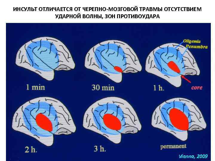 ИНСУЛЬТ ОТЛИЧАЕТСЯ ОТ ЧЕРЕПНО-МОЗГОВОЙ ТРАВМЫ ОТСУТСТВИЕМ УДАРНОЙ ВОЛНЫ, ЗОН ПРОТИВОУДАРА Vienna, 2009 