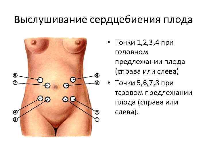 Выслушивание сердцебиения плода • Точки 1, 2, 3, 4 при головном предлежании плода (справа