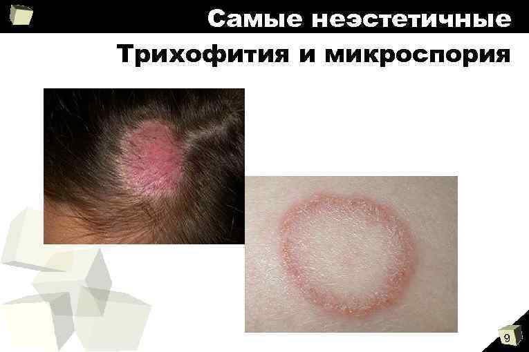 Самые неэстетичные Трихофития и микроспория 9 