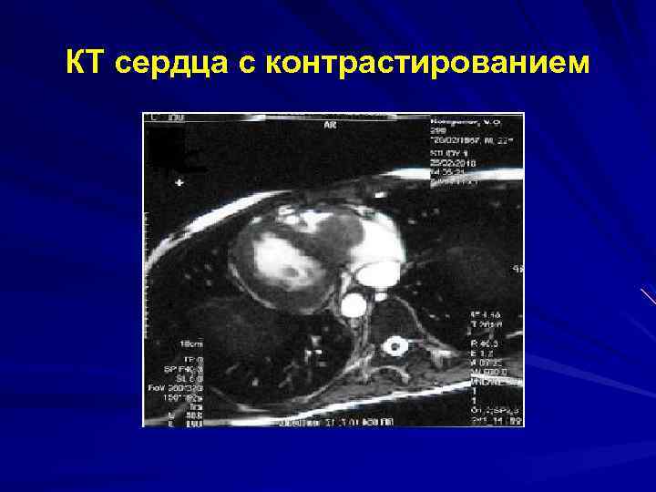 КТ сердца с контрастированием 