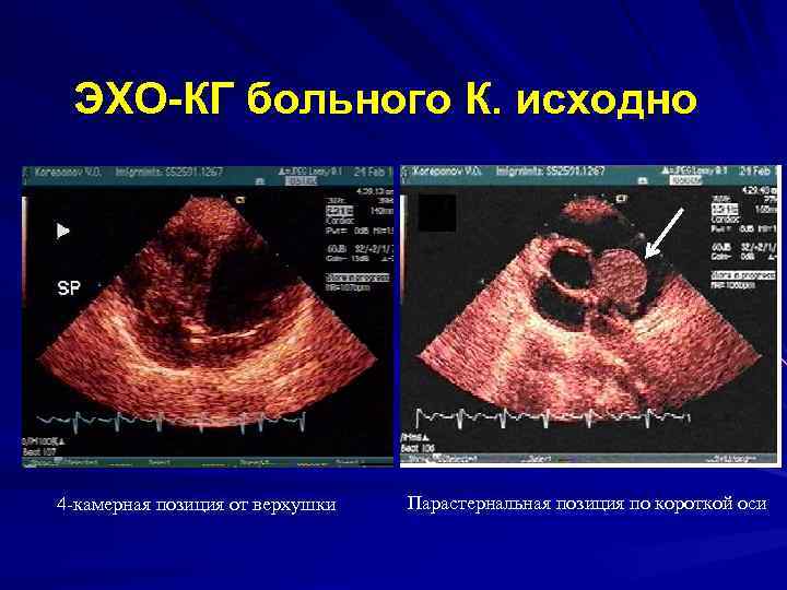 ЭХО-КГ больного К. исходно 4 -камерная позиция от верхушки Парастернальная позиция по короткой оси