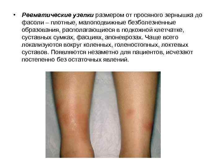  • Ревматические узелки размером от просяного зернышка до фасоли – плотные, малоподвижные безболезненные