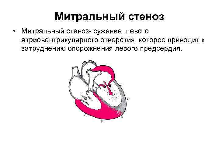 Митральный стеноз • Митральный стеноз сужение левого атриовентрикулярного отверстия, которое приводит к затруднению опорожнения