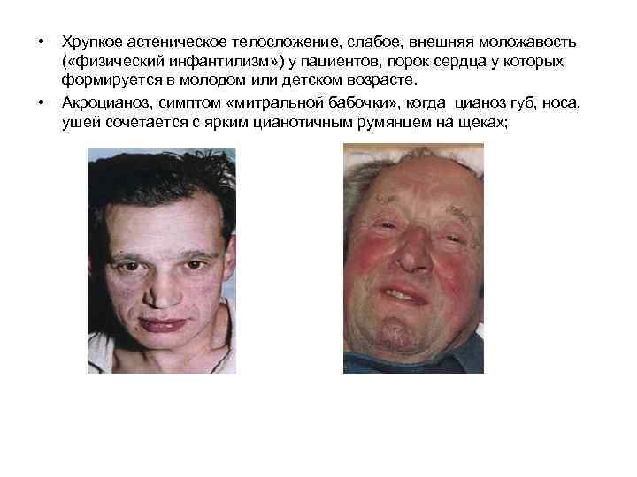  • • Хрупкое астеническое телосложение, слабое, внешняя моложавость ( «физический инфантилизм» ) у