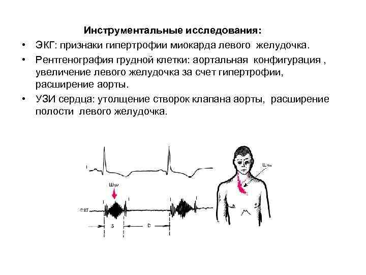  Инструментальные исследования: • ЭКГ: признаки гипертрофии миокарда левого желудочка. • Рентгенография грудной клетки: