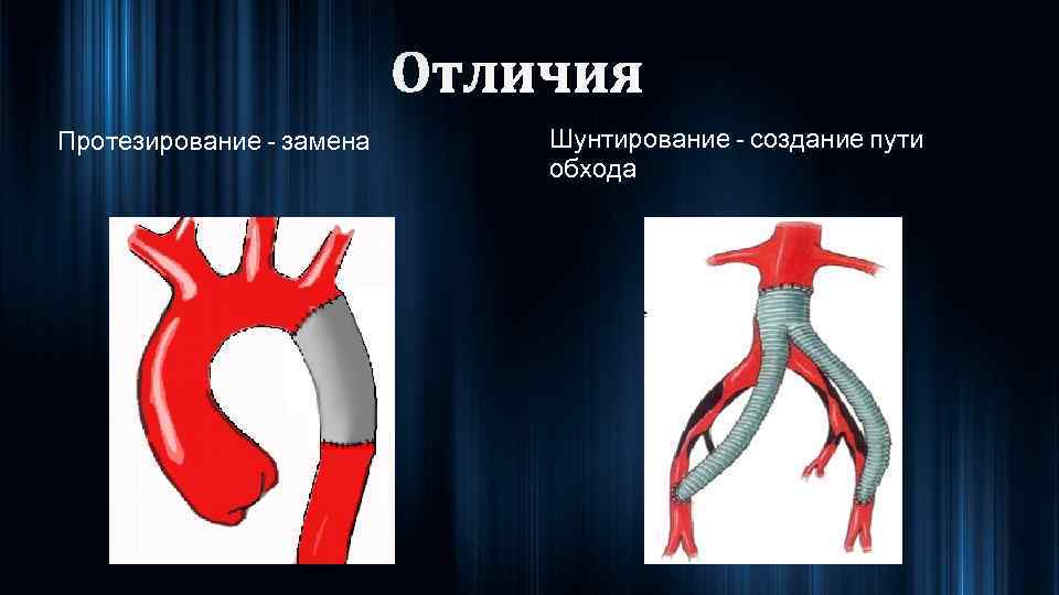 Протезирование - замена Шунтирование - создание пути обхода 