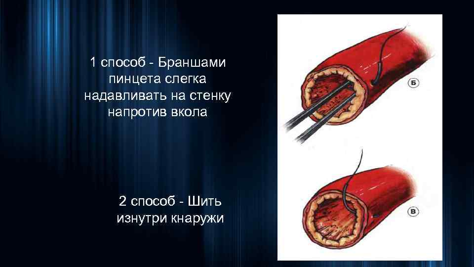 1 способ - Браншами пинцета слегка надавливать на стенку напротив вкола 2 способ -