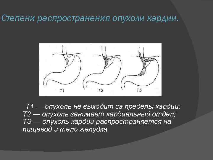 Кардия желудка 2 степени. Степени распространения опухоли. Перегиб желудка классификация. Функциональный Перегиб желудка по степеням.