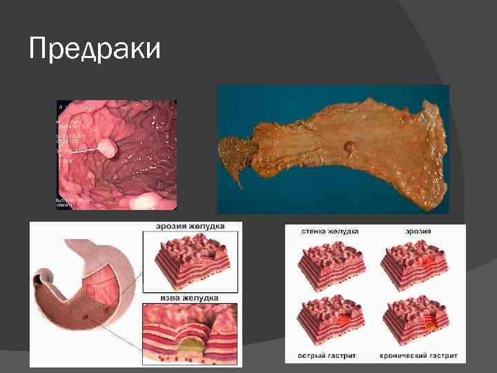 Предраки 