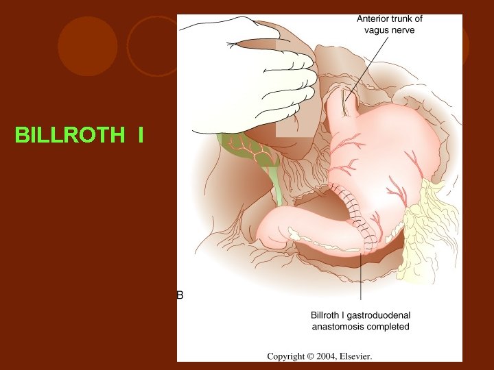 BILLROTH I 