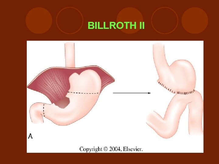 BILLROTH II 