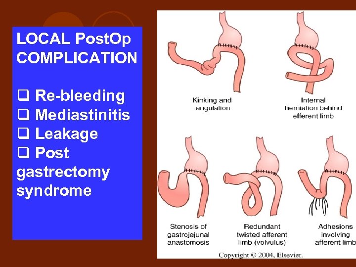 LOCAL Post. Op COMPLICATION q Re-bleeding q Mediastinitis q Leakage q Post gastrectomy syndrome