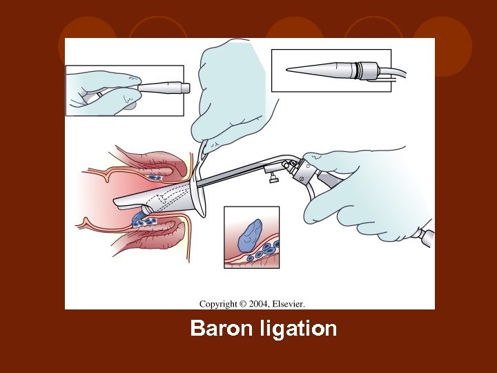 Baron ligation 