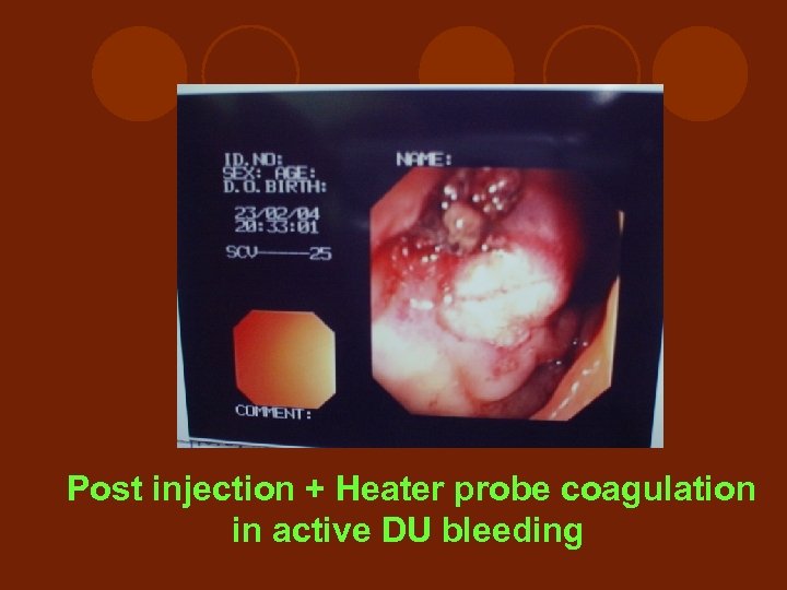 Post injection + Heater probe coagulation in active DU bleeding 