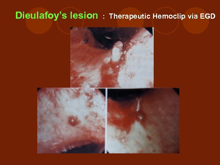 Dieulafoy’s lesion : Therapeutic Hemoclip via EGD 