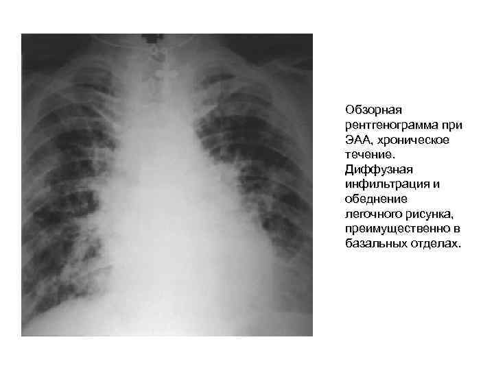 Обзорная рентгенограмма при ЭАА, хроническое течение. Диффузная инфильтрация и обеднение легочного рисунка, преимущественно в