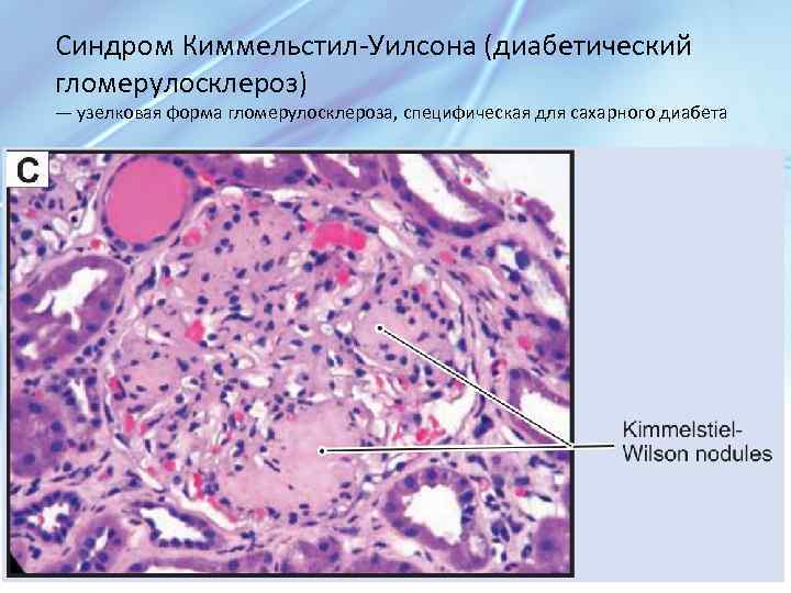Синдром Киммельстил-Уилсона (диабетический гломерулосклероз) — узелковая форма гломерулосклероза, специфическая для сахарного диабета 