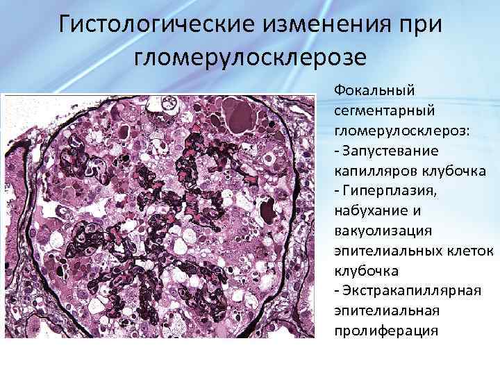 Гистологические изменения при гломерулосклерозе Фокальный сегментарный гломерулосклероз: - Запустевание капилляров клубочка - Гиперплазия, набухание